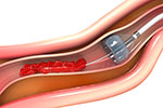 balloon angioplasty