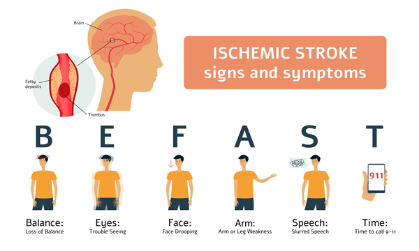 B.E.F.A.S.T. stroke risk factors in women