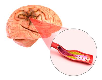 Stroke-brain stroke services